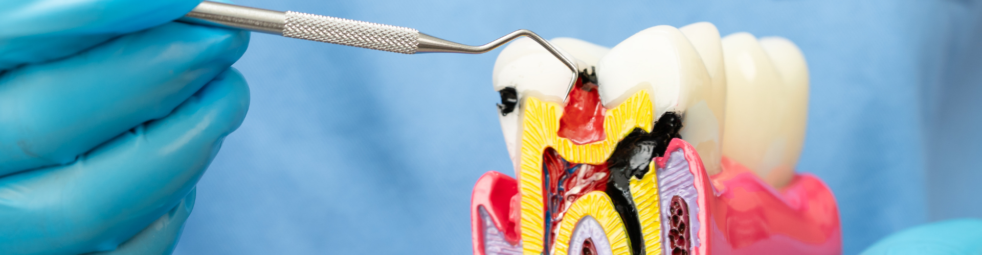 Rego Park Root canal