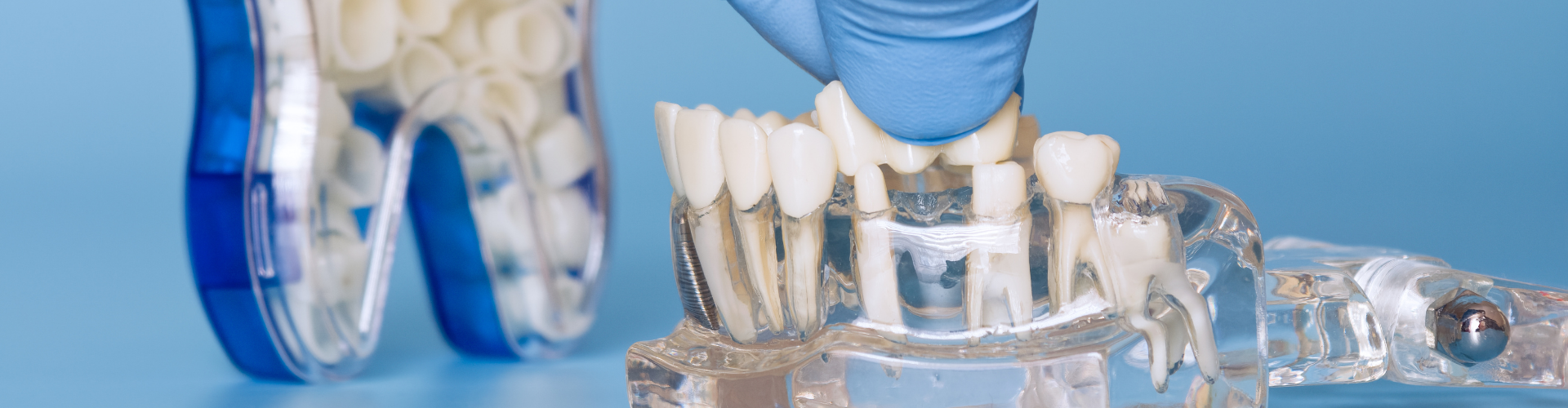 Rego Park Dental Implants