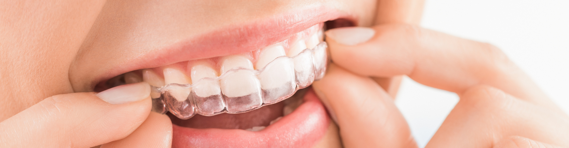  Kew Gardens Teeth Whitening